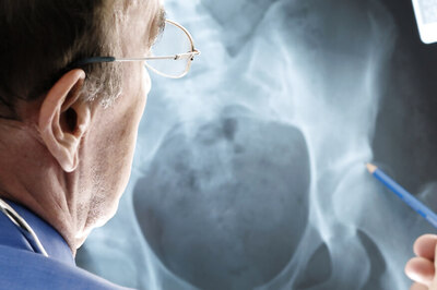 Air Pollution Linked to Osteoporosis-related Bone Fractures