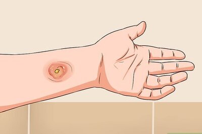 How to Get Rid of MRSA