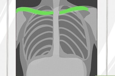 How to Know if a Chest X Ray Film Is Rotated
