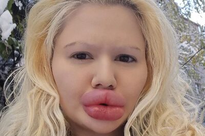 Woman With ‘World's Biggest Lips’ Gifts Herself More Filler For Christmas