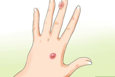 How to Make a Huge Blister Heal