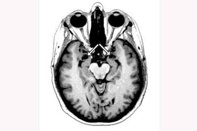 Spiders, snakes? Brain-damaged woman has no fear