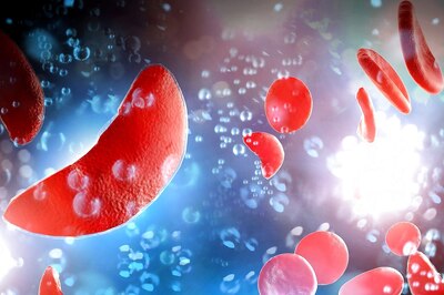 World Sickle Cell Day 2022: What is Sickle Cell Disease? Symptoms, Types, Treatment