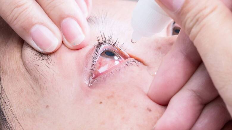 ‘Madras Eye’ Troubles Tamil Nadu as Nearly 4,000 Cases Being Reported Every Day This Monsoon