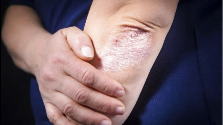 World Psoriasis Day: Know Everything About Psoriasis