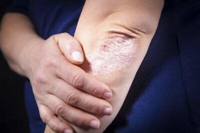 World Psoriasis Day: Know Everything About Psoriasis