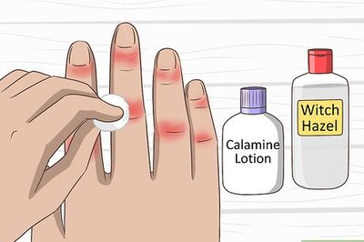 How to Get Rid of Chilblains