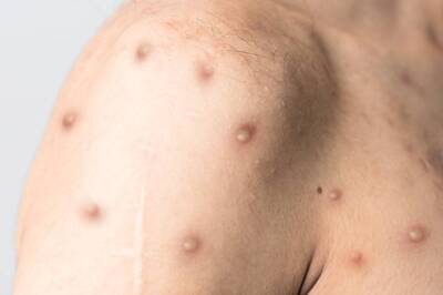 Contact of Delhi Monkeypox Patient Complained of Body Ache, Being Monitored