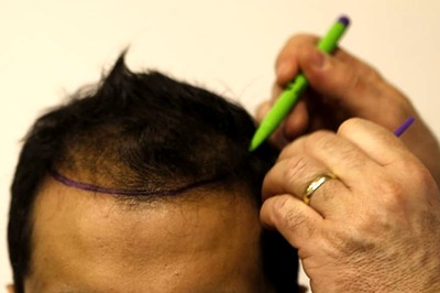 Researchers Find Answer to Hair Loss in Existing Drug