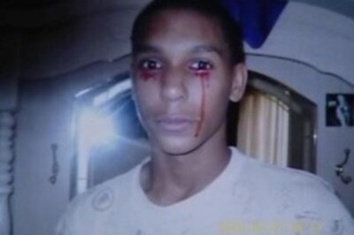 US teen who cries blood gets help from experts
