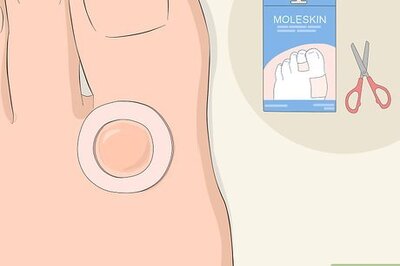 How to Dry Up Edema Blisters