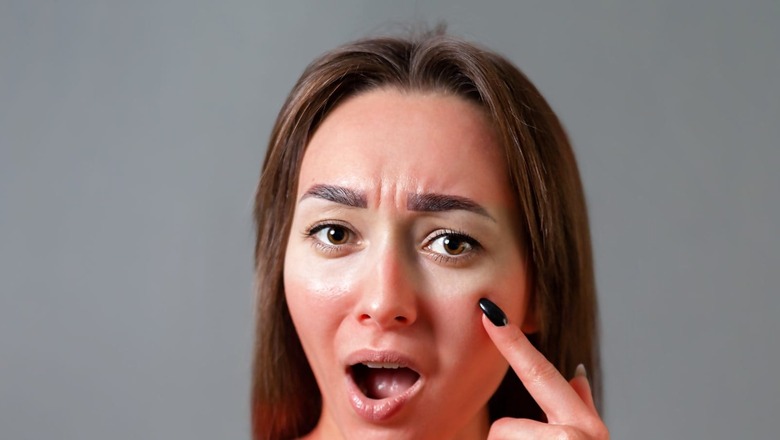 Ways for Healing Skin Burns