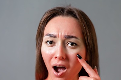 Ways for Healing Skin Burns