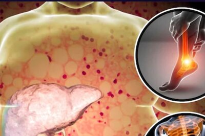 Global Fatty Liver Day 2024: What Is The Specific Cause Of Hepatomegaly And Fatty Liver?