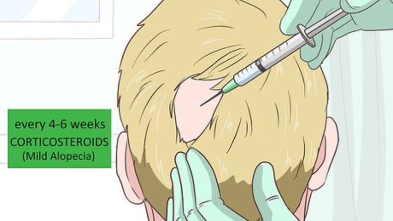 How to Treat Alopecia