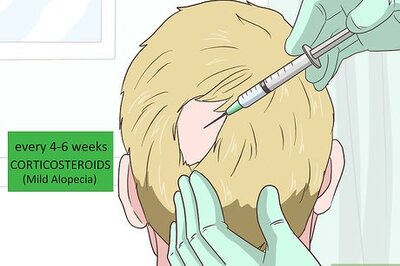 How to Treat Alopecia