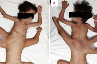 Indonesia: Rare Conjoined Twins' Mobility Restored Through Complex Bone Surgery