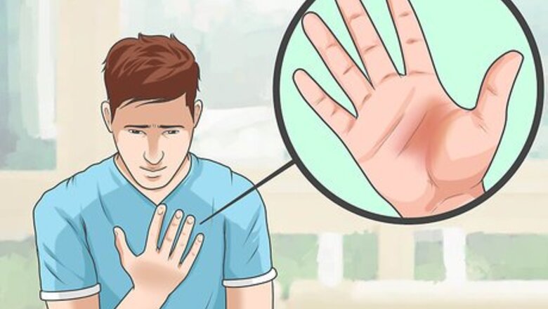 How to Take the Sting out of a Burn