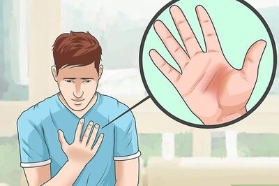 How to Take the Sting out of a Burn
