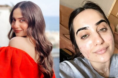 Kusha Kapila Reveals How She Got Rid Of Acne, Recommends Diet Changes And Home Remedies