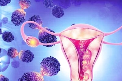 Gynaecological Cancers: Know Types, Symptoms And Preventive Measures