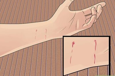 How to Treat a Cat Bite