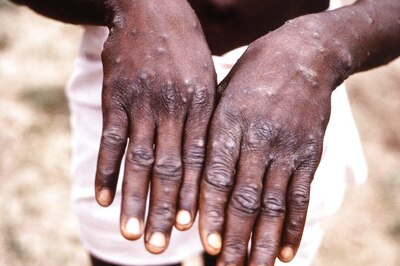 Monkeypox: Govt Asks Officials to Send Suspected Sick Passengers' Samples from Affected Nations to NIV