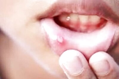 Is Mouth Ulcer Making Your Life Miserable? Here are 6 Home Remedies
