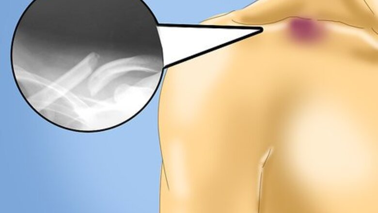 How to Treat a Clavicle Fracture