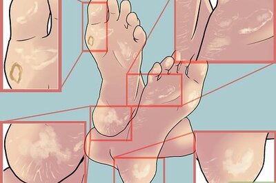 How to Know if You Have Corns