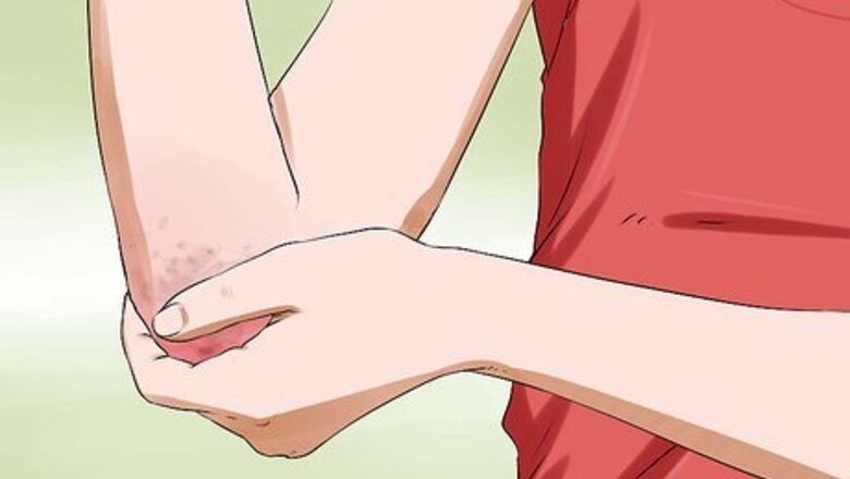 How to Know if You Have Eczema