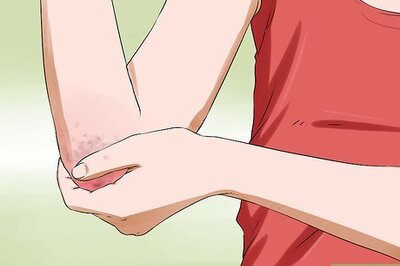 How to Know if You Have Eczema