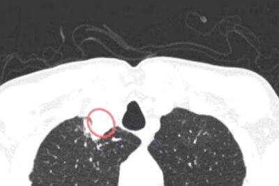 Kolkata Man Becomes World's First to Catch Fungal Infection from Plant, Says Report