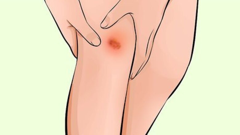 How to Treat Scars