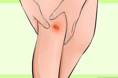 How to Treat Scars