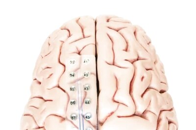 UK Hospital Running Trials To Reverse Parkinson’s Disease’s Symptoms Using Brain Device