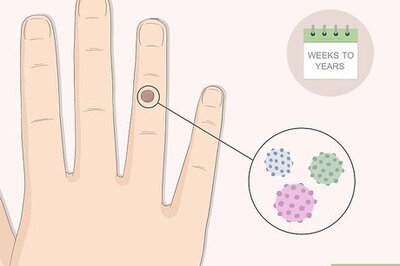 How to Get Rid of Warts