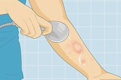 How to Get Rid of Bug Bites