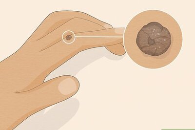 How to Identify Warts