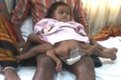 First phase of surgery on Baby Lakshmi successful