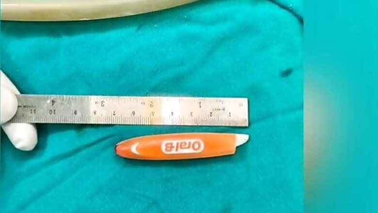 Toothbrush Gets Stuck Under Woman's Eye, Successfully Removed Surgically in Karnataka