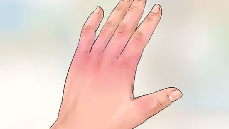 How to Treat Frostbite