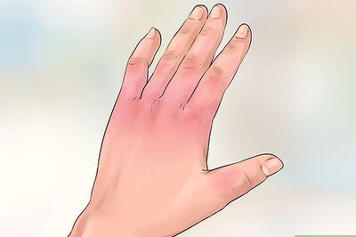 How to Treat Frostbite