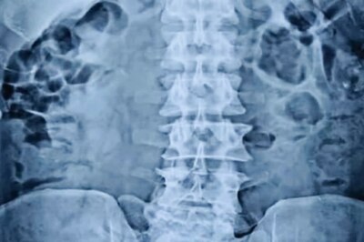 In Bihar's Muzaffarnagar, Doctors Remove a Piece of Glass From Patient's Stomach