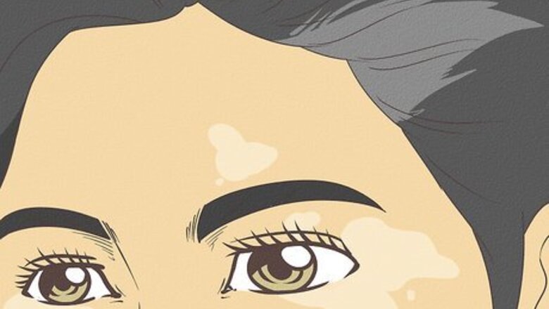How to Diagnose Vitiligo