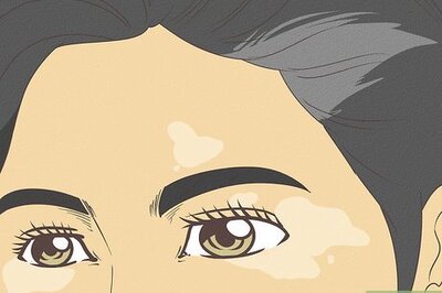 How to Diagnose Vitiligo