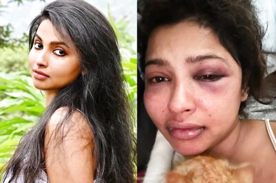 Malayalam Actor Anicka Vikhraman Accuses Ex Anoop Pillai of Assaulting Her, Shares Pics of Bruises