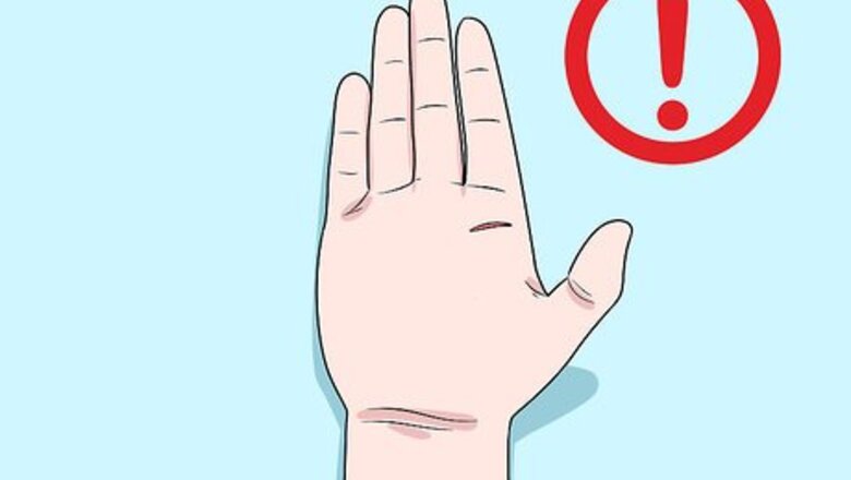 How to Prevent Cellulitis